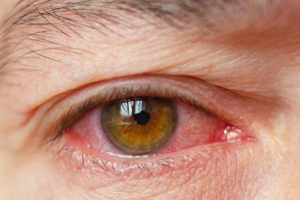 How to reduce the risk of dry eyes?